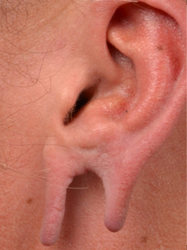 Earlobe Surgery Before & After Image