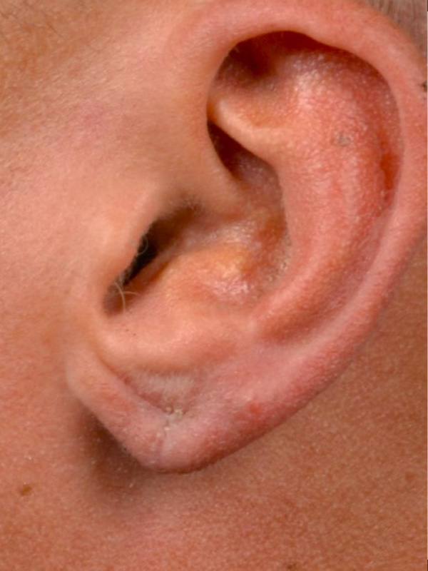 Earlobe Surgery Before & After Image
