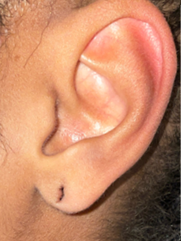 Earlobe Surgery Before & After Image
