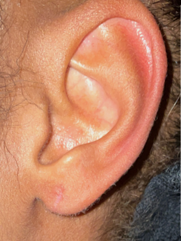 Earlobe Surgery Before & After Image