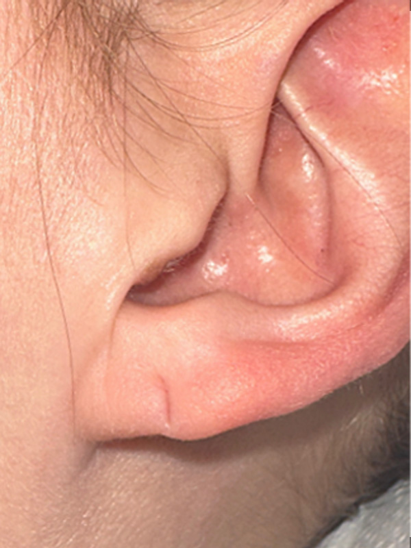 Earlobe Surgery Before & After Image