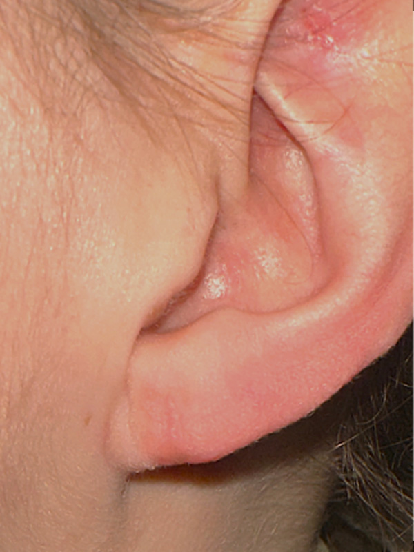 Earlobe Surgery Before & After Image