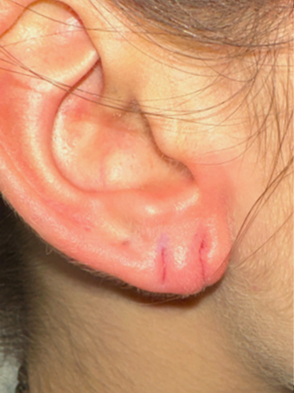Earlobe Surgery Before & After Image