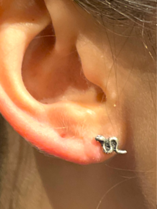 Earlobe Surgery Before & After Image