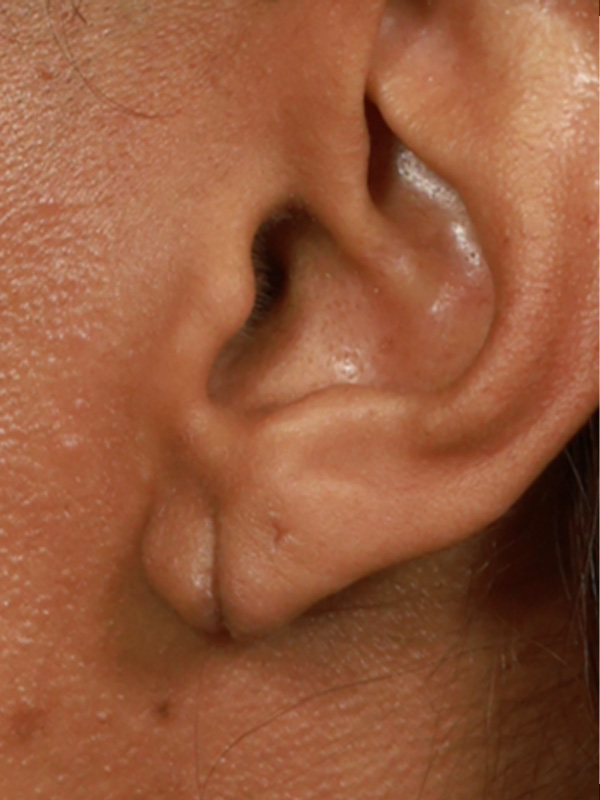 Earlobe Surgery Before & After Image