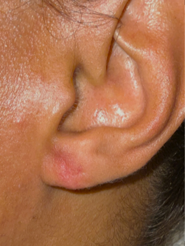 Earlobe Surgery Before & After Image