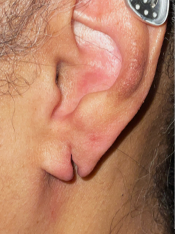 Earlobe Surgery Before & After Image