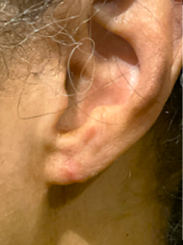 Earlobe Surgery Before & After Image