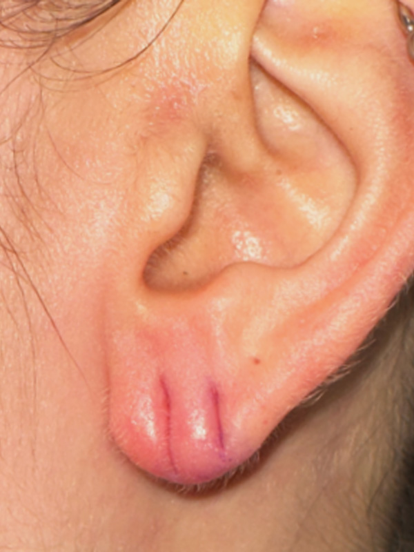 Earlobe Surgery Before & After Image