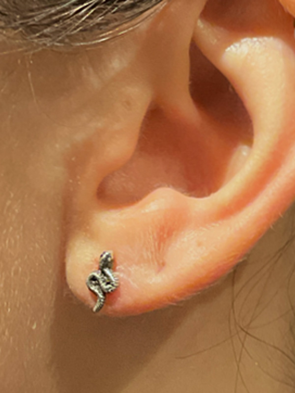 Earlobe Surgery Before & After Image