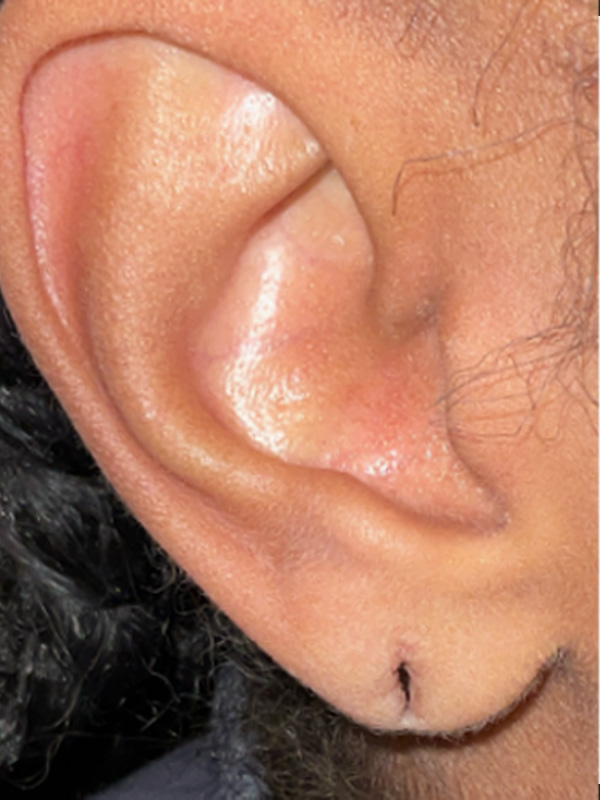 Earlobe Surgery Before & After Image