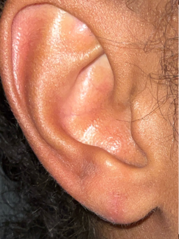 Earlobe Surgery Before & After Image