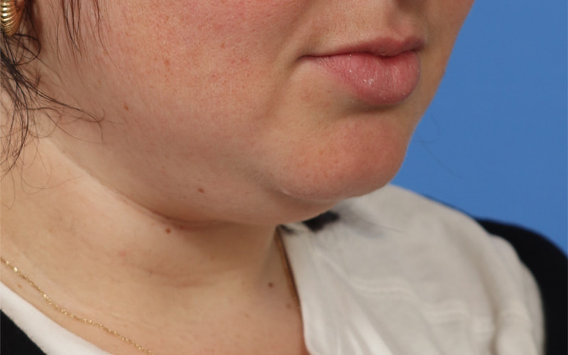 Neck Liposuction Before & After Image