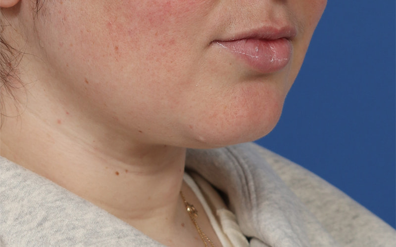 Neck Liposuction Before & After Image