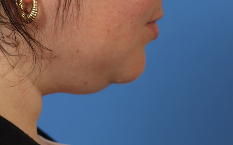 Neck Liposuction Before & After Image