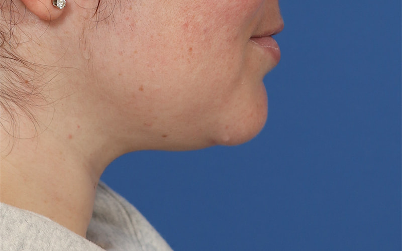 Neck Liposuction Before & After Image