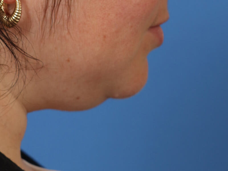 Neck Liposuction Before & After Image