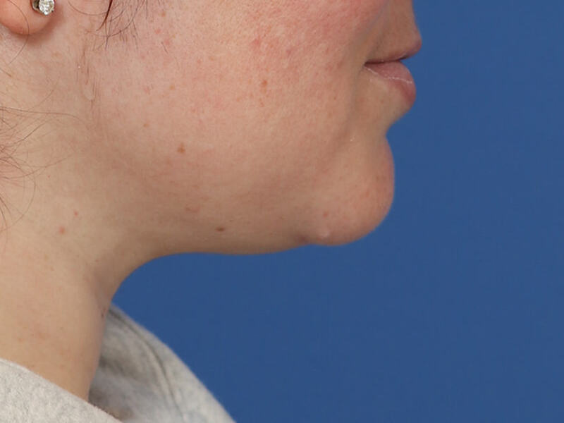Neck Liposuction Before & After Image