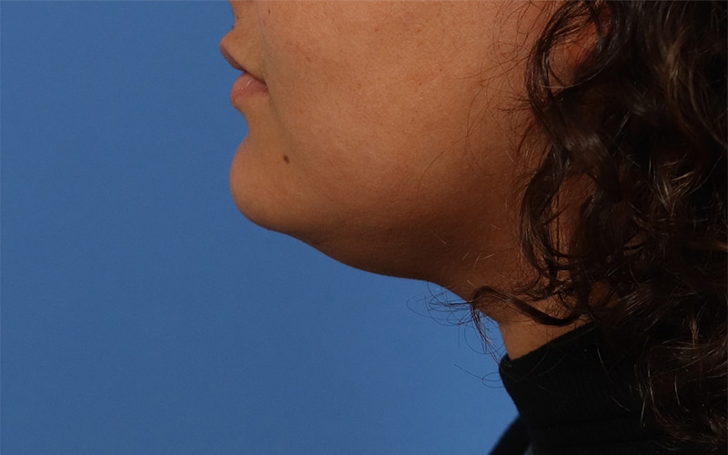 Neck Liposuction Before & After Image