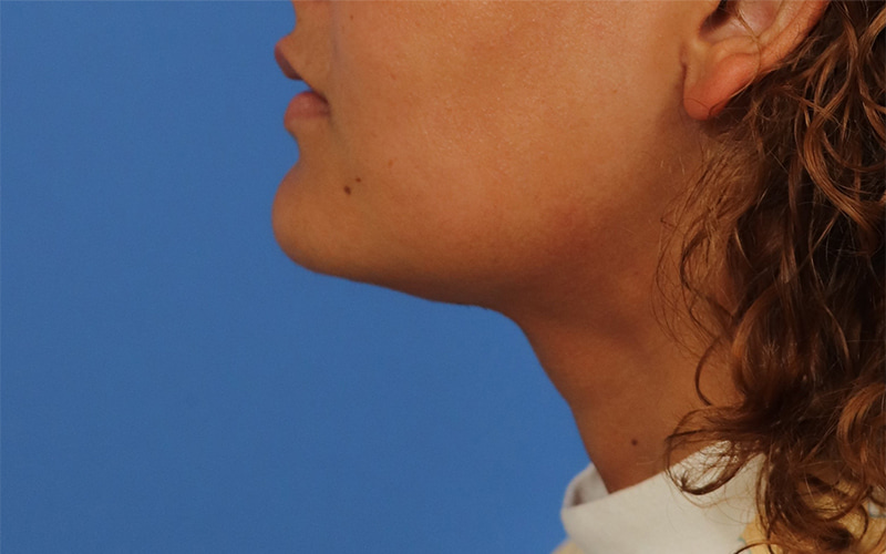 Neck Liposuction Before & After Image