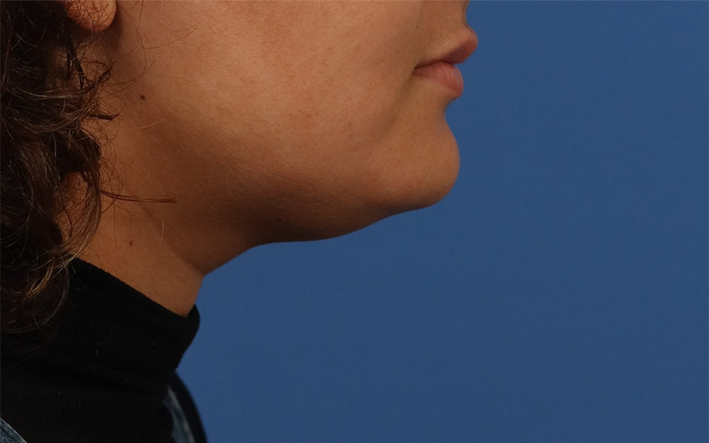Neck Liposuction Before & After Image