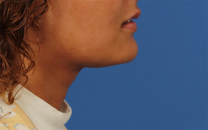 Neck Liposuction Before & After Image