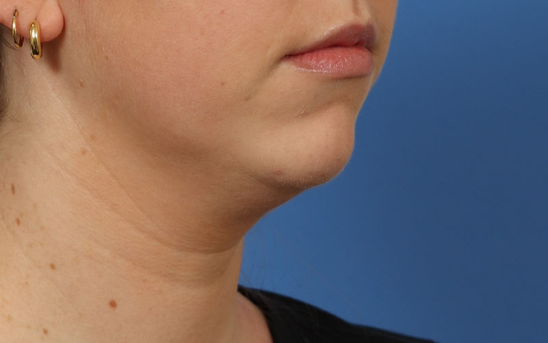 Neck Liposuction Before & After Image