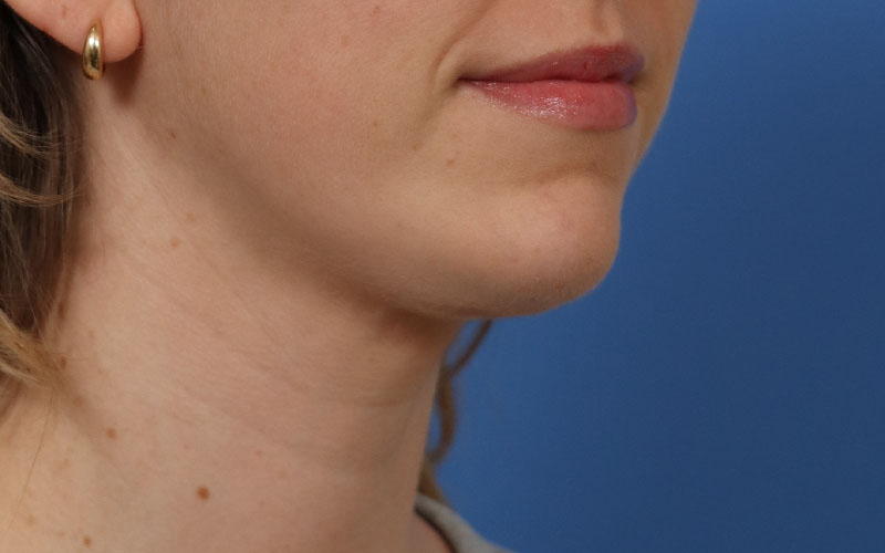 Neck Liposuction Before & After Image