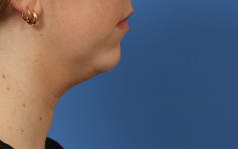 Neck Liposuction Before & After Image