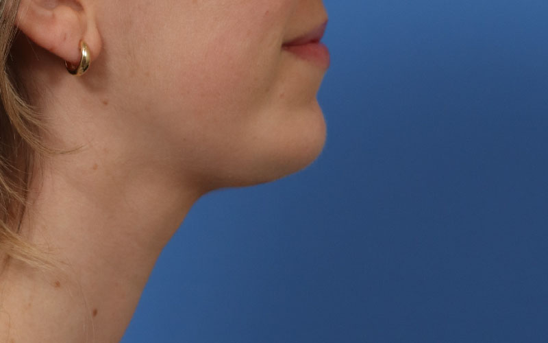 Neck Liposuction Before & After Image
