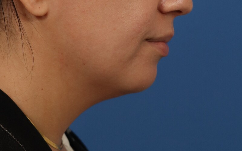 Neck Liposuction Before & After Image