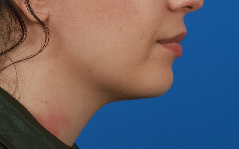 Neck Liposuction Before & After Image