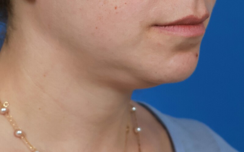 Neck Liposuction Before & After Image