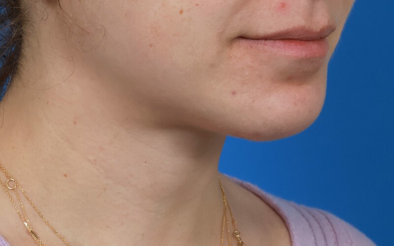 Neck Liposuction Before & After Image