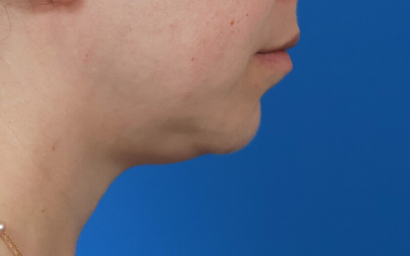 Neck Liposuction Before & After Image