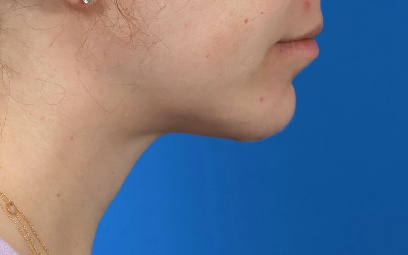 Neck Liposuction Before & After Image