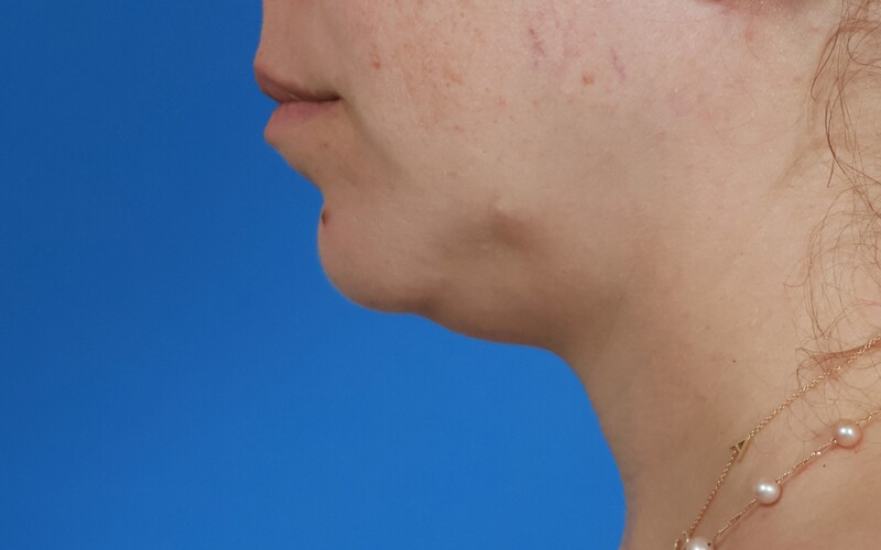 Neck Liposuction Before & After Image