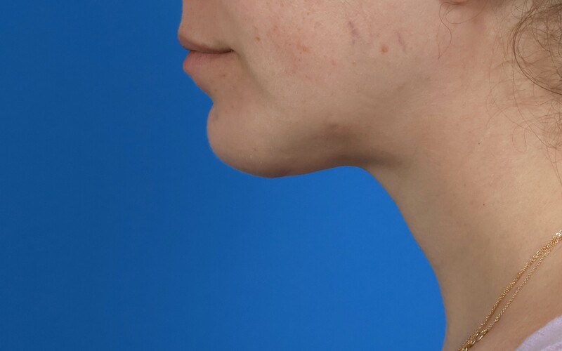 Neck Liposuction Before & After Image