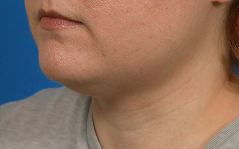 Neck Liposuction Before & After Image