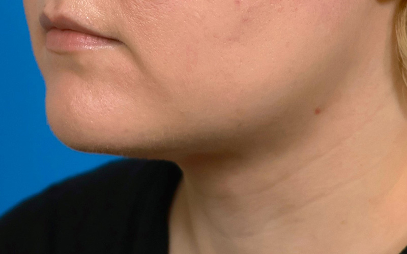 Neck Liposuction Before & After Image