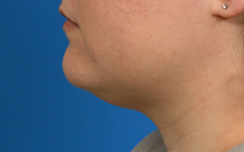 Neck Liposuction Before & After Image