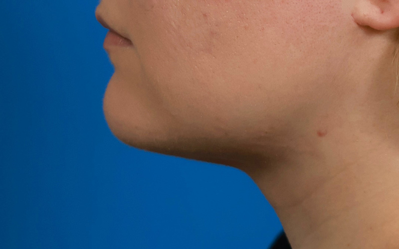 Neck Liposuction Before & After Image