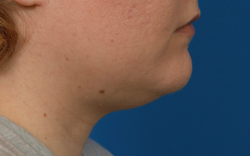 Neck Liposuction Before & After Image
