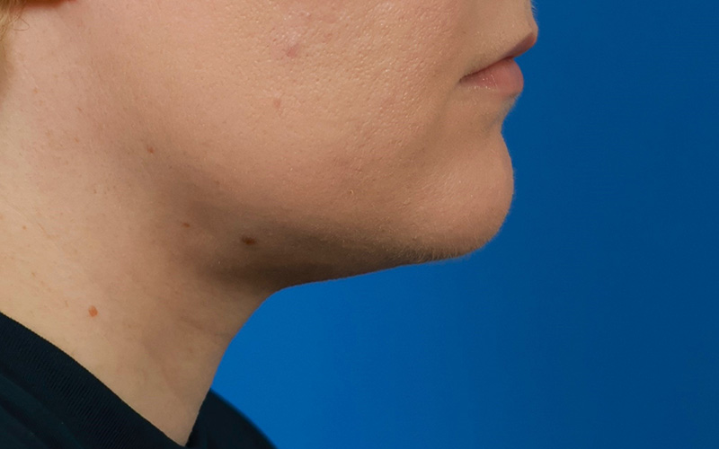 Neck Liposuction Before & After Image