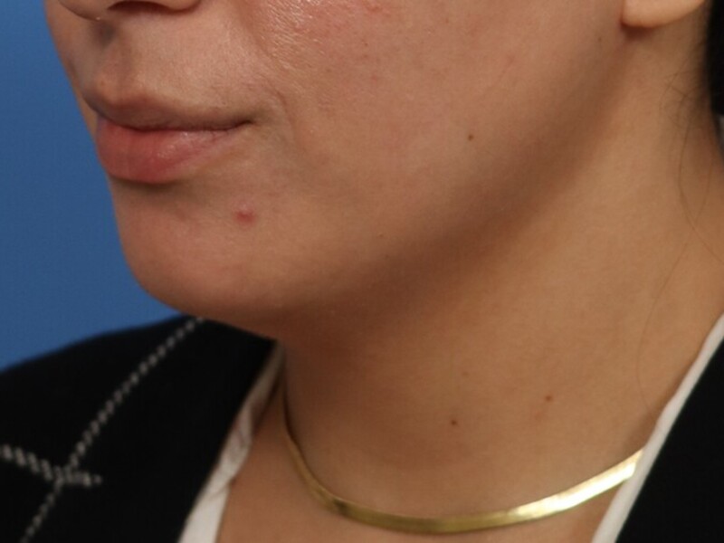 Neck Liposuction Before & After Image