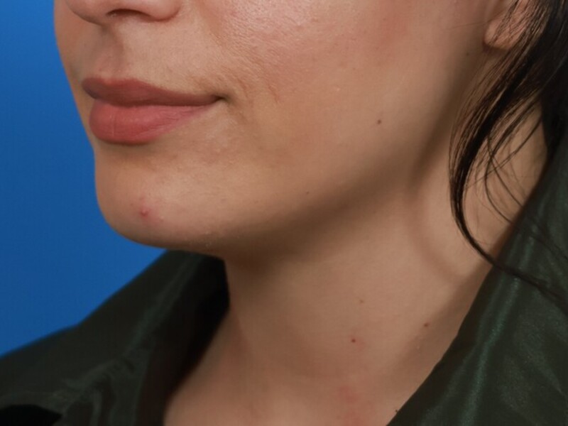 Neck Liposuction Before & After Image