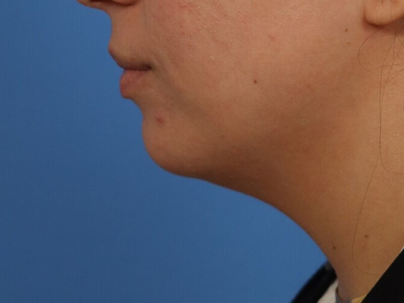Neck Liposuction Before & After Image