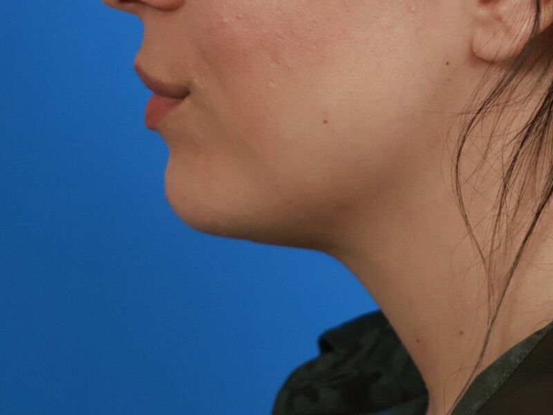 Neck Liposuction Before & After Image