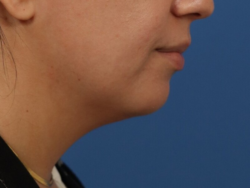 Neck Liposuction Before & After Image