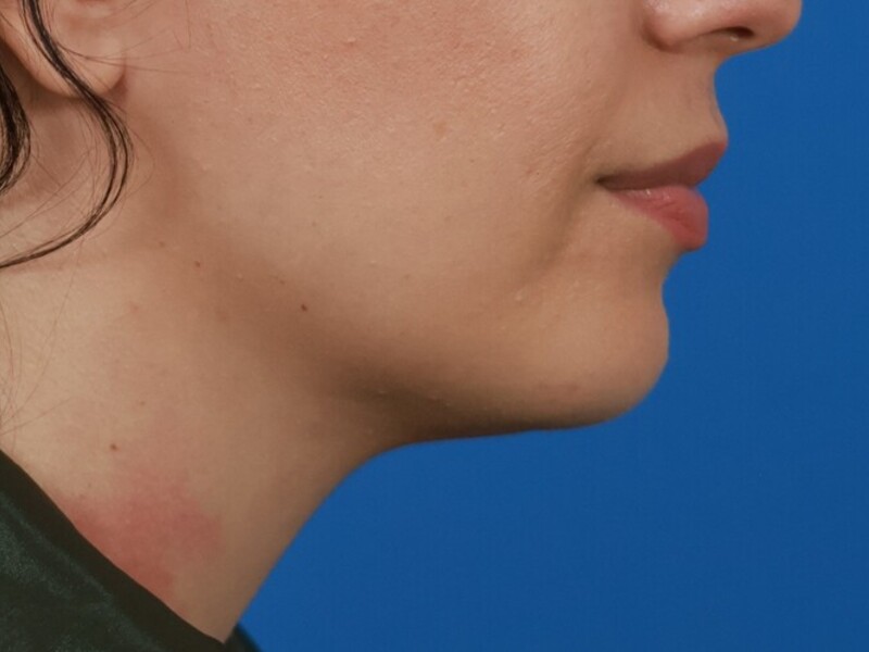 Neck Liposuction Before & After Image